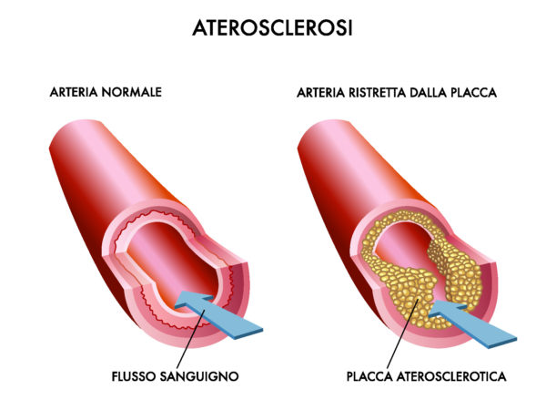 Chirurgia vascolare Lecce: l'arteriosclerosi, cos'è e come curarla