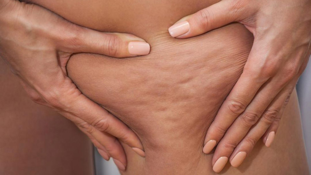 Cellulite e adiposità localizzate, cause e soluzioni attraverso la Medicina Estetica