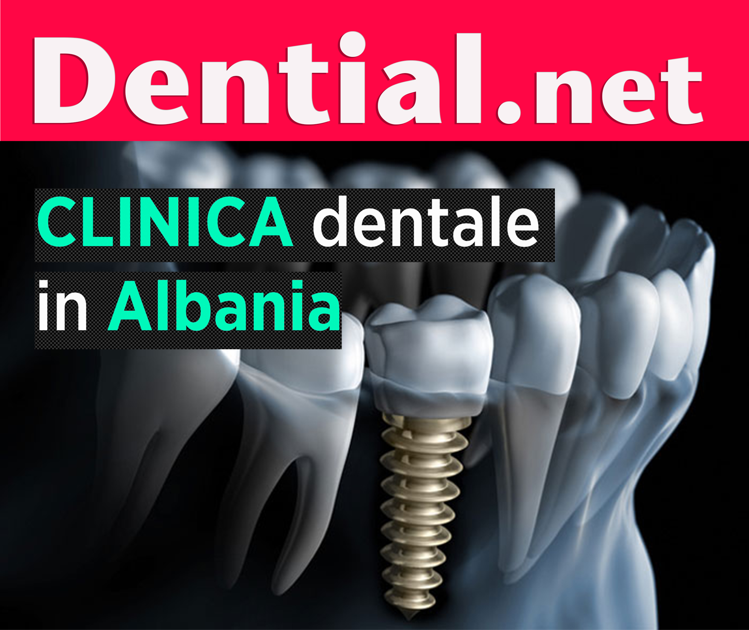 Quanto costa un impianto dentale in Albania