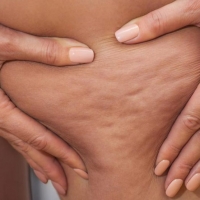 Cellulite e adiposità localizzate, cause e soluzioni attraverso la Medicina Estetica