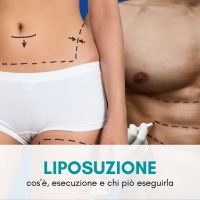 Tutto sulla Liposuzione: cos’è, esecuzione, chi può eseguirla