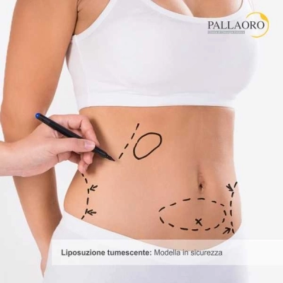 La liposuzione migliora la qualità della vita