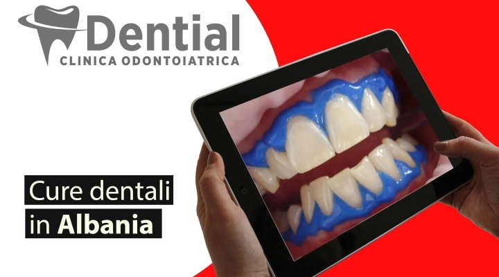 Impianti dentali in Albania