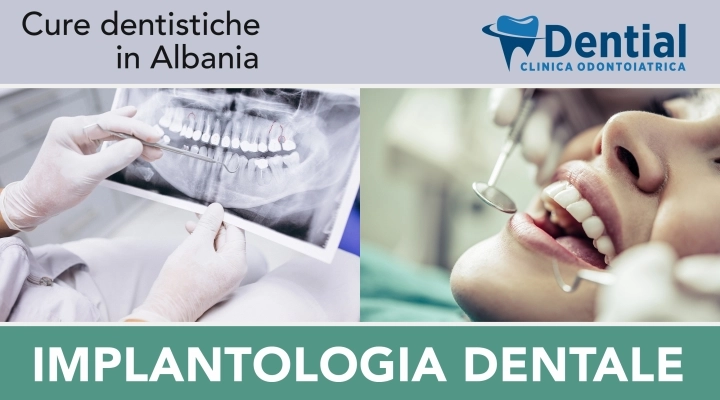 I dentisti in Albania e le cliniche odontoiatriche di Durazzo per la cura dei denti di pazienti italiani