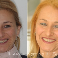 Faccette dentali: a Roma un sorriso bello e sano in tempo record