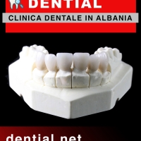 Corone dentali in Albania e capsule per i denti in porcellana a Durazzo
