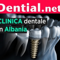 Quanto costa un impianto dentale in Albania