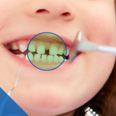Ortodonzia infantile abitudini corrette fin da bambini | Centro Odontoiatrico Ceccaioni a Frascati