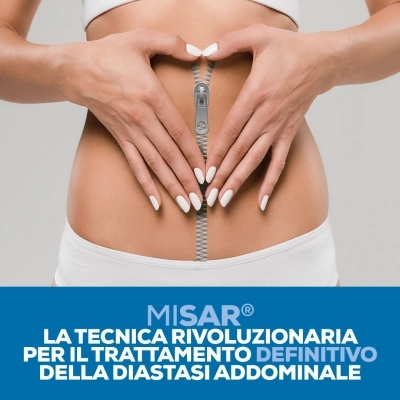 Clinica Villa Rizzo: Innovazione e Cura della Diastasi Addominale con miSAR